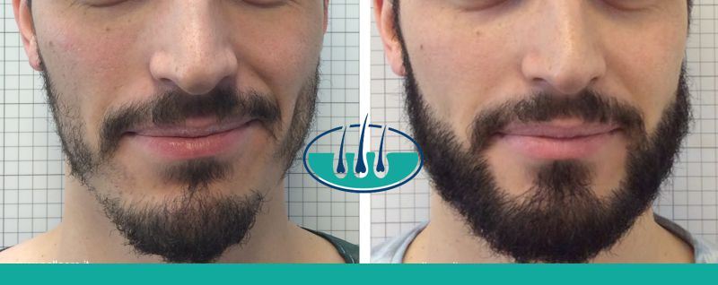 Trento: Costo del trapianto capelli