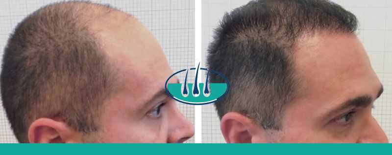 Cervignano del Friuli: Costo del trapianto capelli