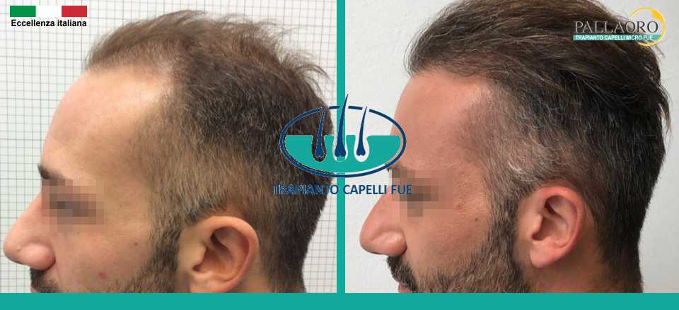 impianto capelli sintetici