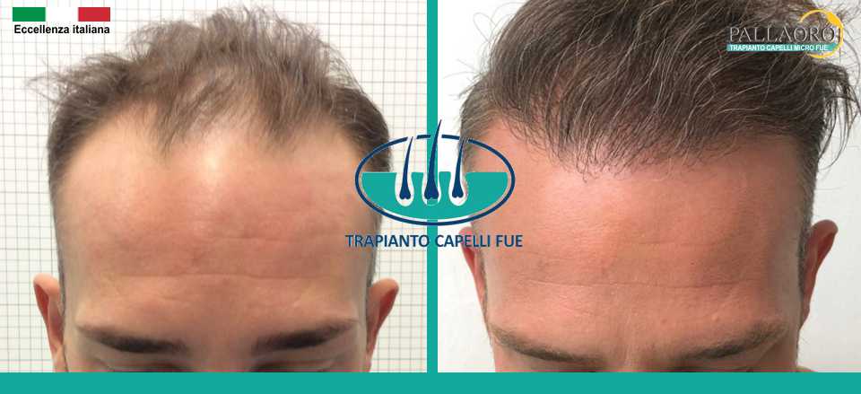 Trapianto capelli Rho: micro chirurgia, prezzi e consulenza